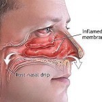 Treatments For Sinus Infection Symptoms