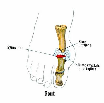 How to Prevent Or Treat Gout